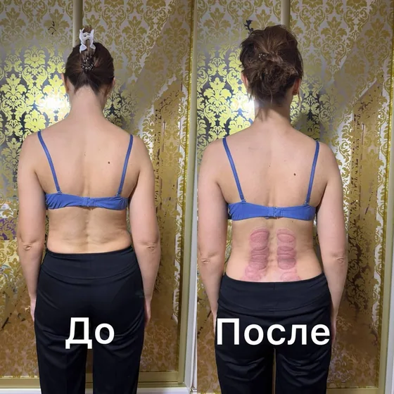Баночный массаж, поясница: фото до и после сеанса