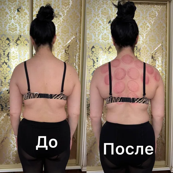 Баночный массаж, спина: фото до и после сеанса