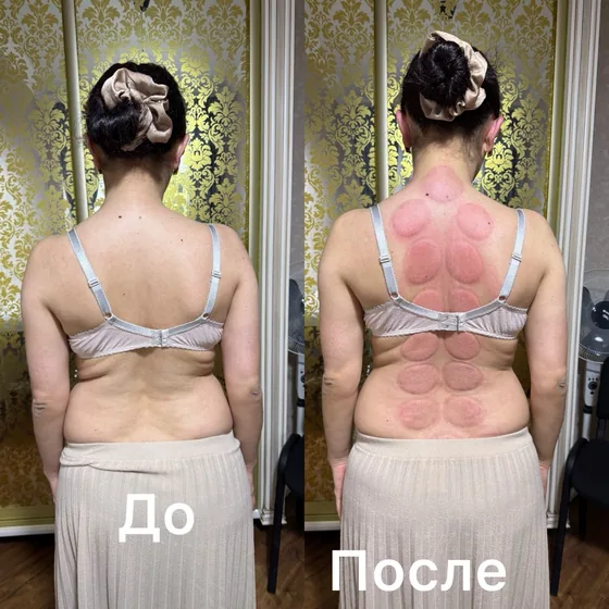Баночный массаж, спина: фото до и после сеанса