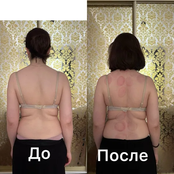 Баночный массаж, спина: фото до и после сеанса