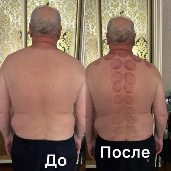 Баночный массаж, спина: фото до и после сеанса